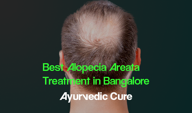 Best Alopecia Areata Treatment in Bangalore: Ayurvedic Cure at Vijayan Master's Ayurveda