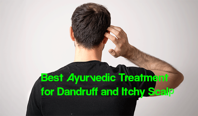 Best Ayurvedic Treatment for Dandruff and Itchy Scalp