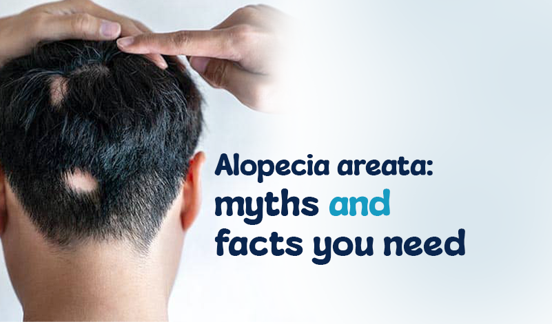Alopecia Areata: Myths and Facts You Need